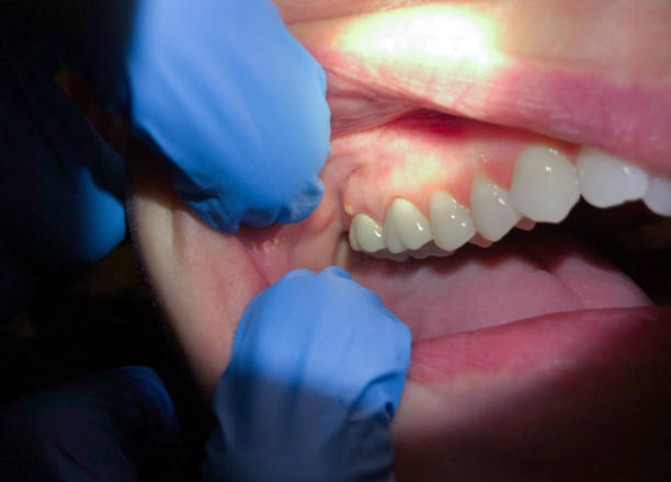 Best Emergency Gum Treatment in North Sioux City, SD