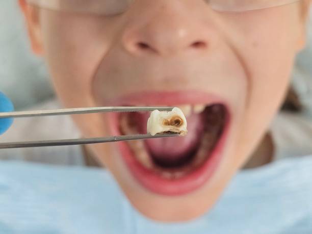 Best Emergency Wisdom Teeth Removal in North Sioux City, SD